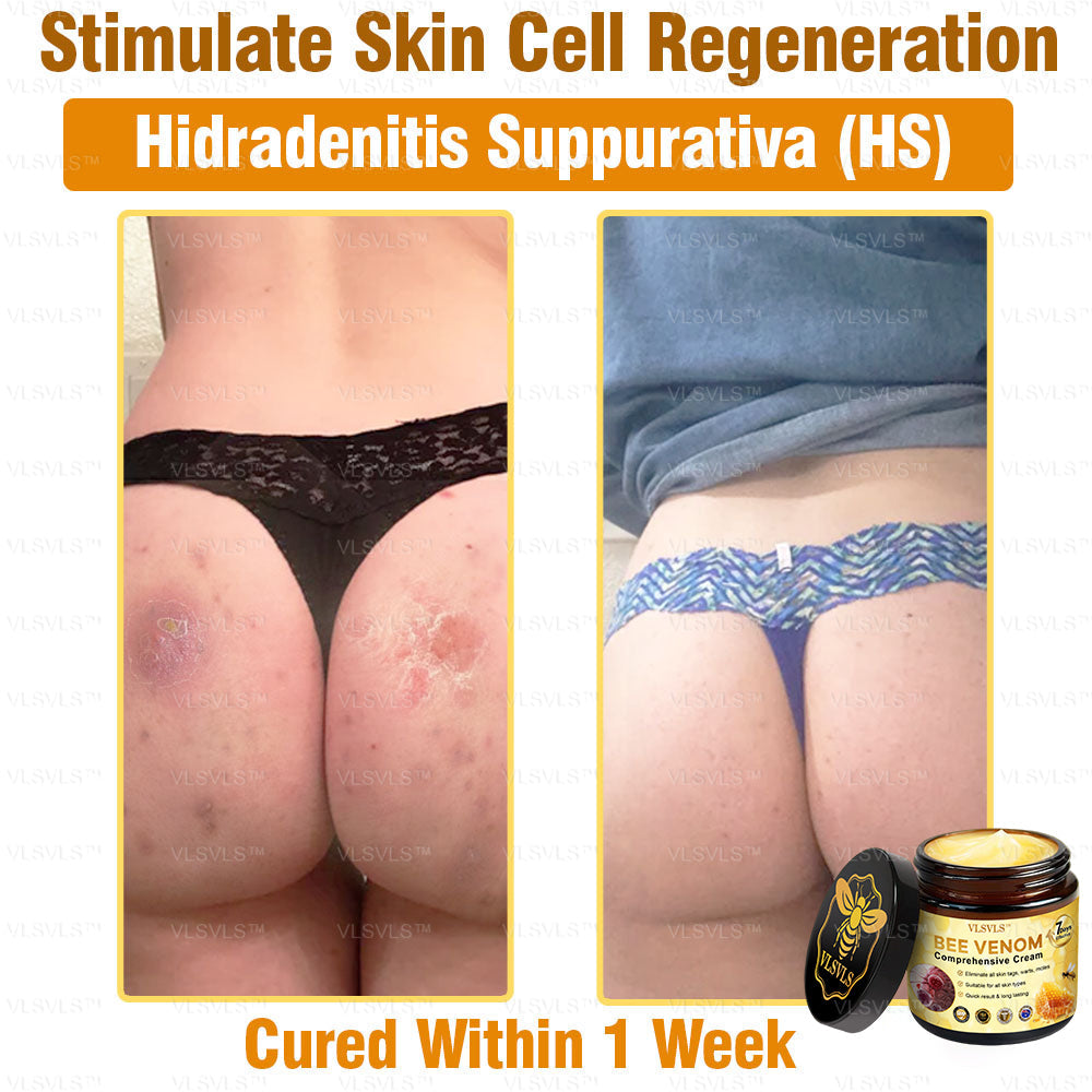 VLSVLS™ Bee Venom Comprehensive Cream 🌸🌸(Suitable for all ages & TGA recommends)